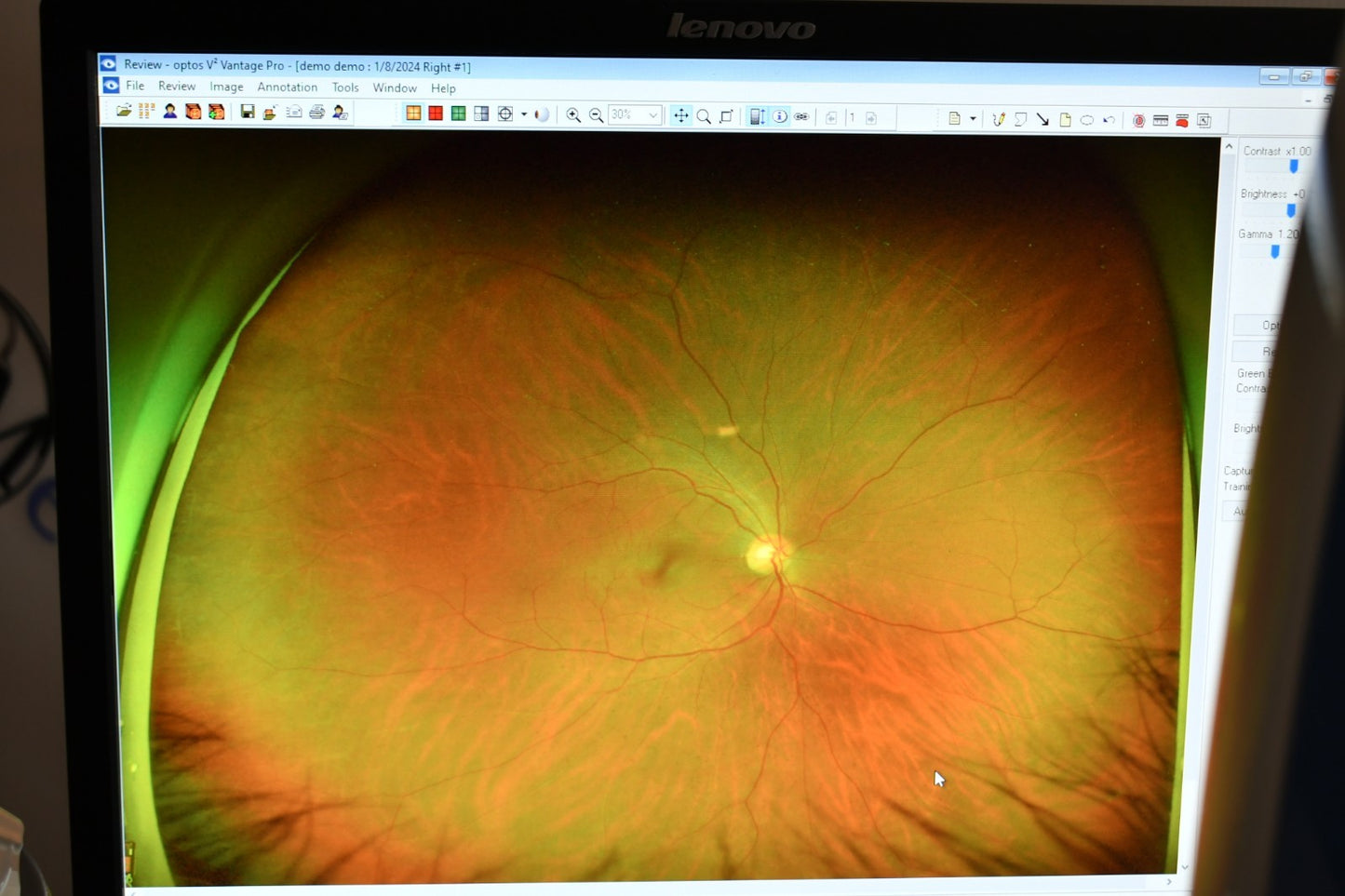 Refurbished Optos California RG AF FFA ICG retinal Camera offered by Visumed Equipment