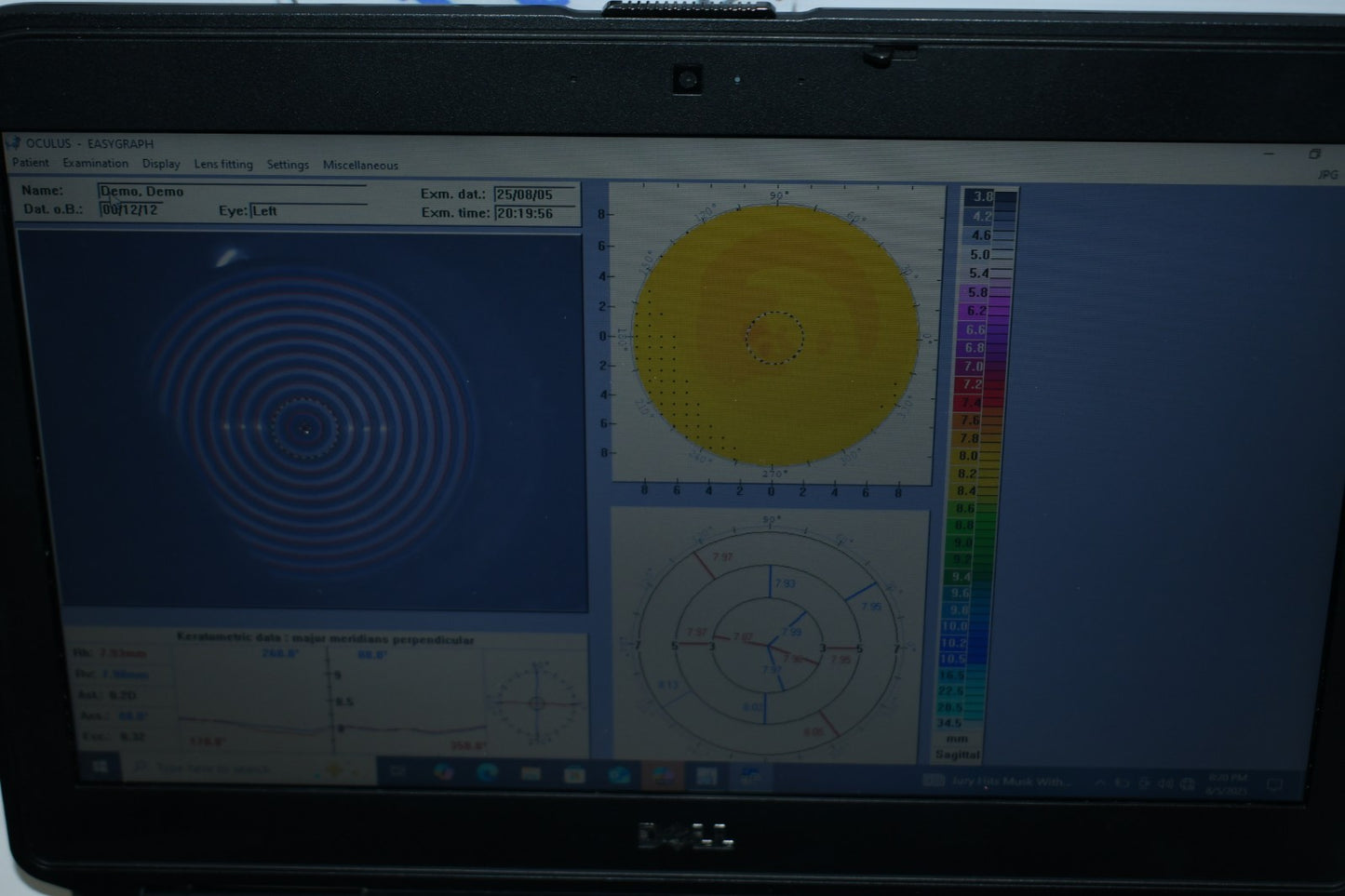 Oculus Easygraph Corneal topographer portable and slitlamp mountable