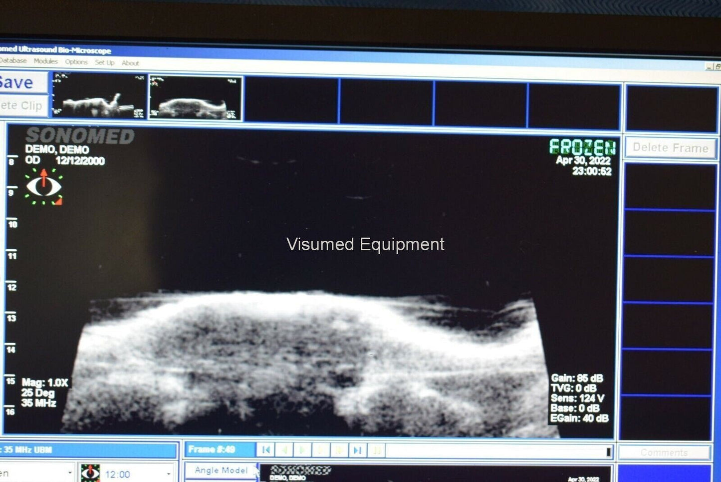 Refurbished Sonomed Vumax II UBM Ophthalmic Ultrasound Biomicroscopy Glaucoma offered by Visumed Equipment