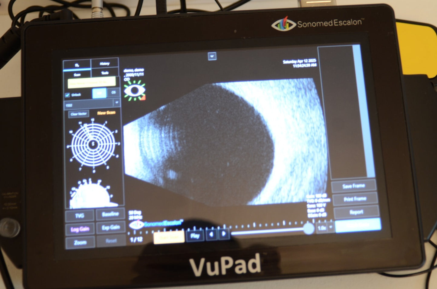 Sonomed  Escalon Vupad  A-scan B-scan and UBM