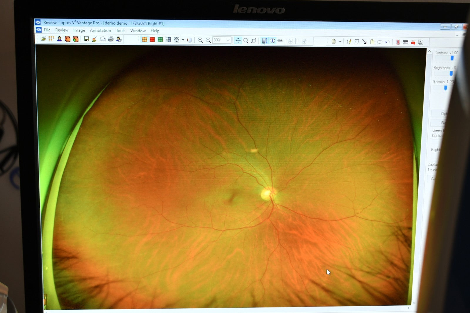 Refurbished Optos California RG AF FFA ICG retinal Camera offered by Visumed Equipment