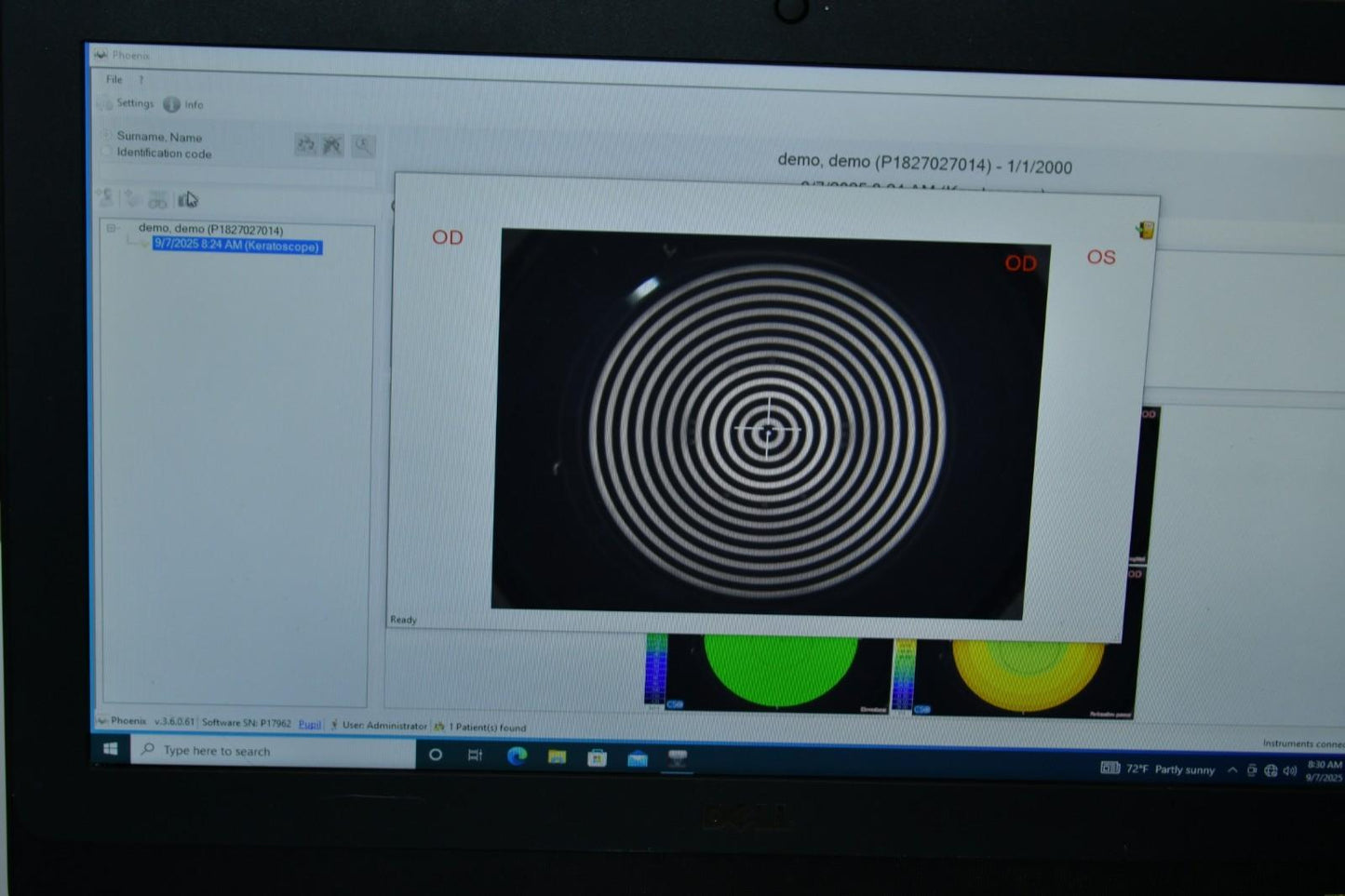 Lumenis ANTARES Corneal Topographer