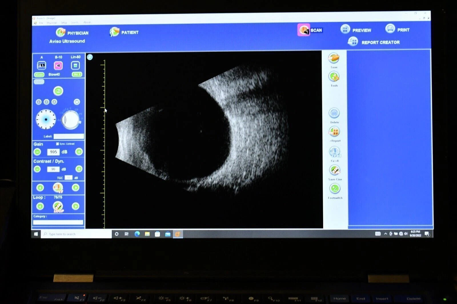 Quantel Aviso S A-Scan, B-Scan and UBM Ophthalmic Ultrasound