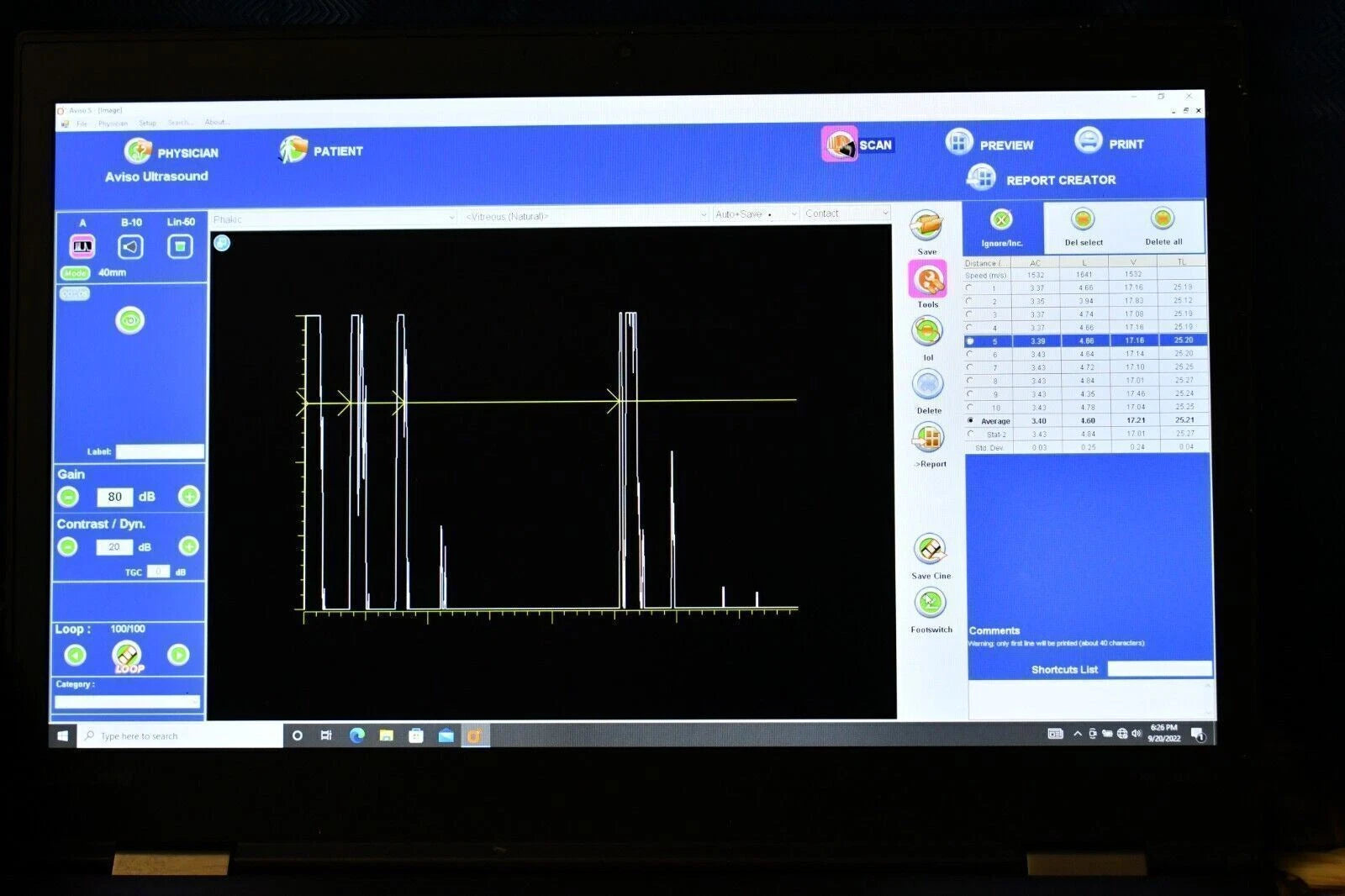 Quantel Aviso S A-Scan, B-Scan and UBM Ophthalmic Ultrasound