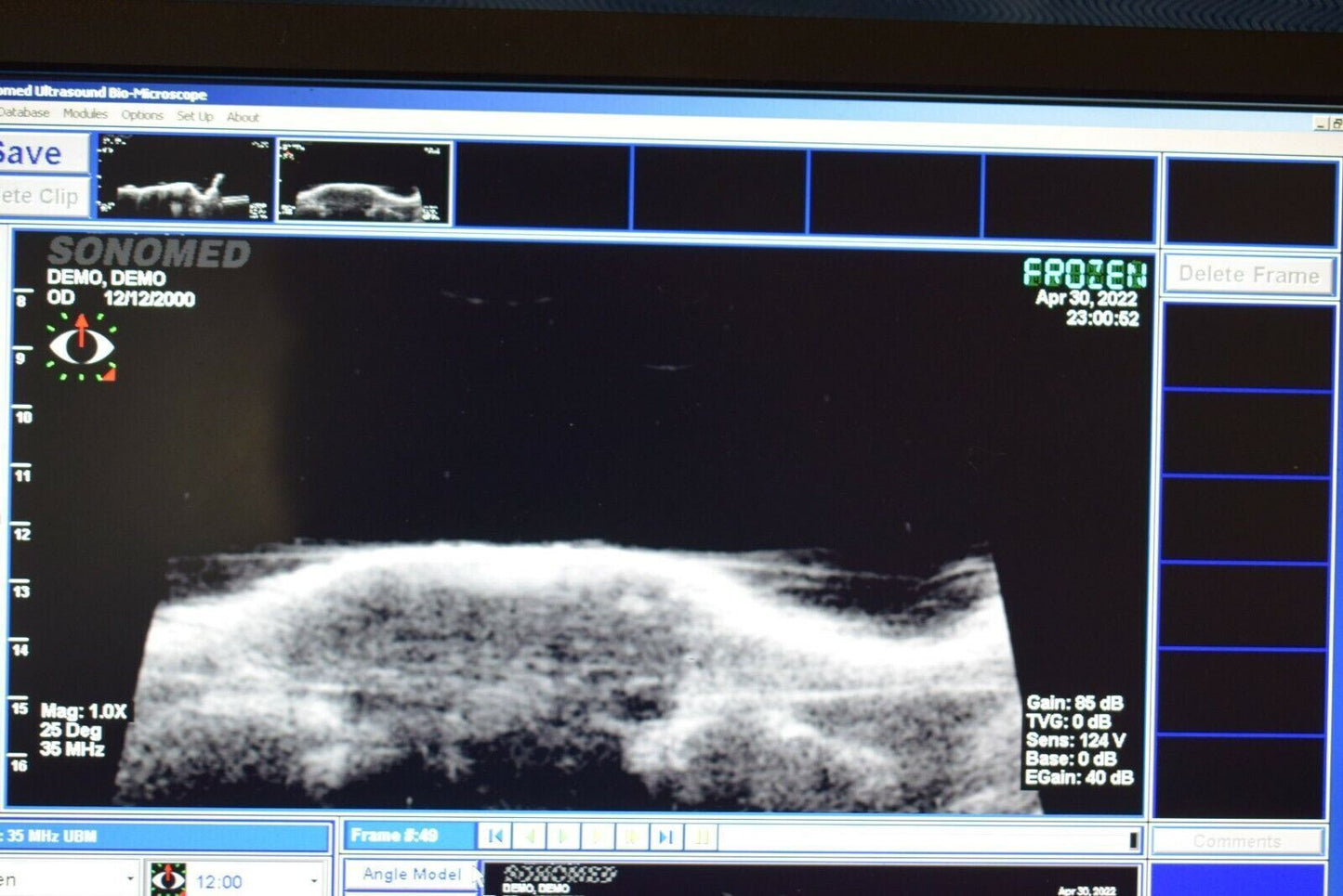 Sonomed Vumax II UBM Ophthalmic Ultrasound Biomicroscopy Glaucoma
